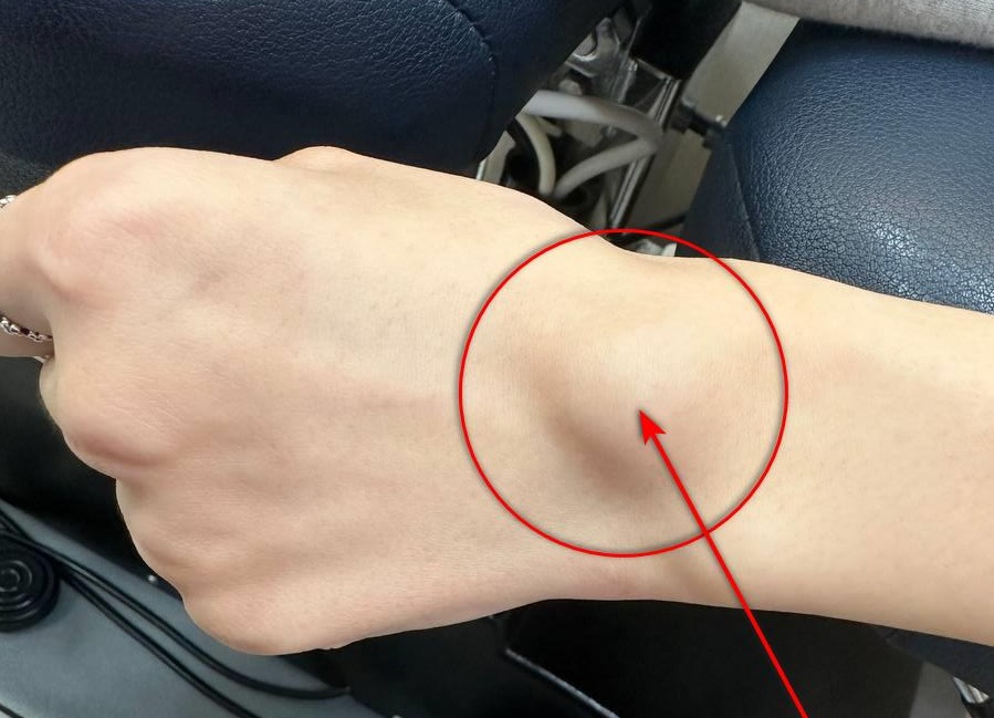 단순히 혹만 튀어나오는 게 아닙니다 — 통증과 저림, 신경 압박