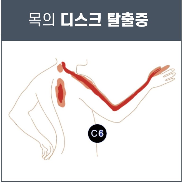 목 디스크 증상, 목 디스크 견인기 [특화된 디스크 치료기]