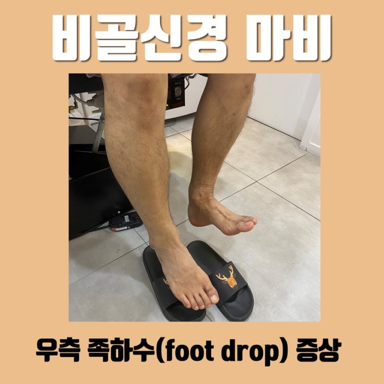 비골신경 마비, 족하수(foot drop)증상과 치료