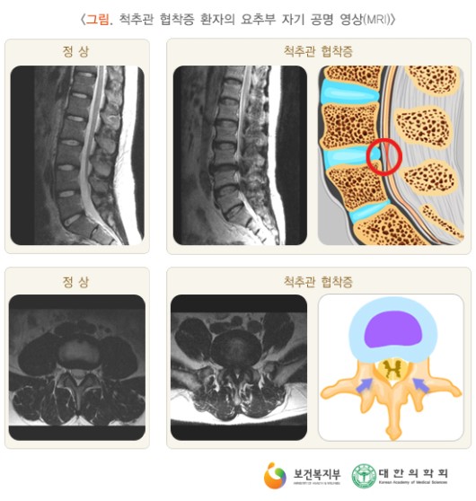 심각한 협착증에 대한 비수술 요법 논문 발표 [화곡역 추나 한의원]