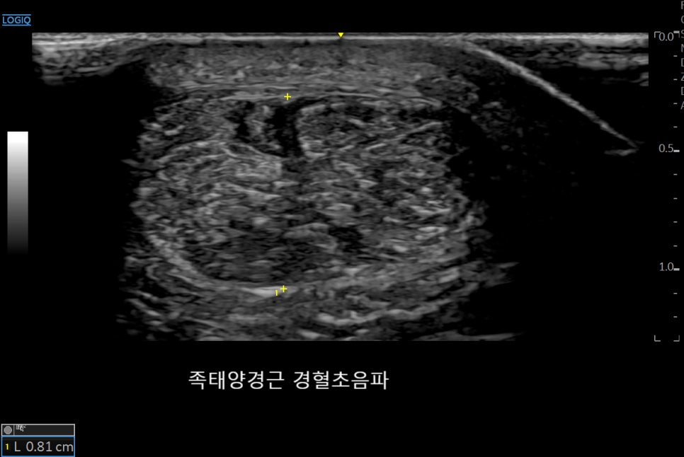 경혈에 주사바늘이 삽입된 발 부위 초음파 영상 — 초음파 유도하 약침 시술 | 서울 바로한의원