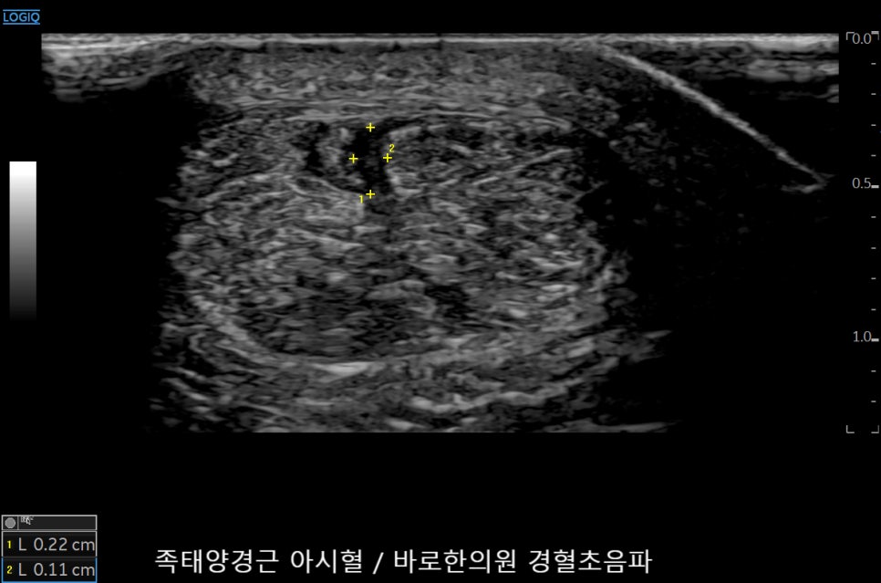 족태양경근 아시혈 부위를 촬영한 초음파 이미지로, 노란색 십자 표시와 측정값이 보인다 — 초음파 정밀 진단 | 서울 바로한의원 초음파 약침·도침·침도