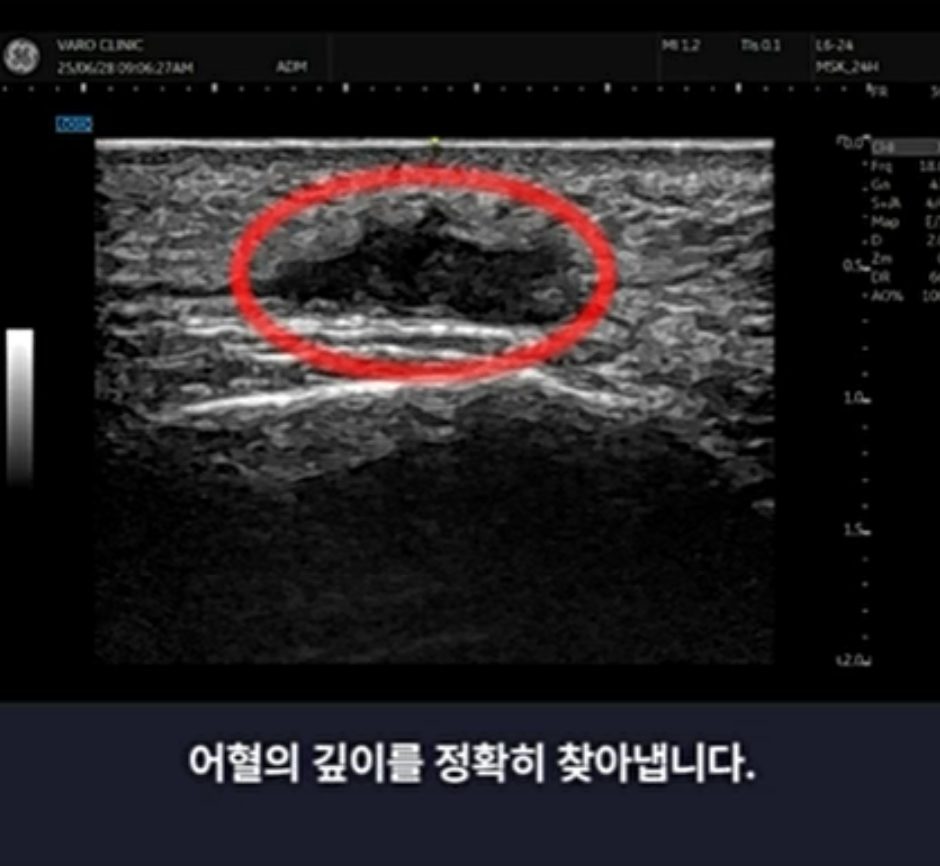 초음파 화면에 붉은 원으로 표시된 어둡고 불규칙한 형태의 혈종이 보인다.