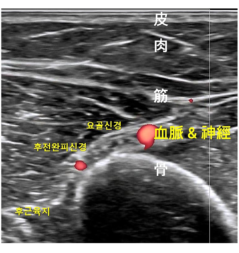 초음파 이미지에 피부, 근육, 뼈, 요골신경, 후전완피신경, 혈관 및 신경이 표시되어 있다.