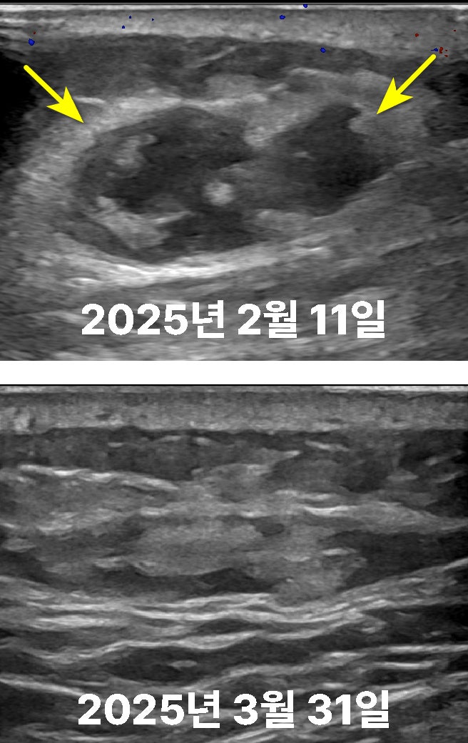 2025년 2월 11일과 3월 31일의 초음파 영상으로, 타박상으로 생긴 혈종이 점차 치유되는 모습입니다.