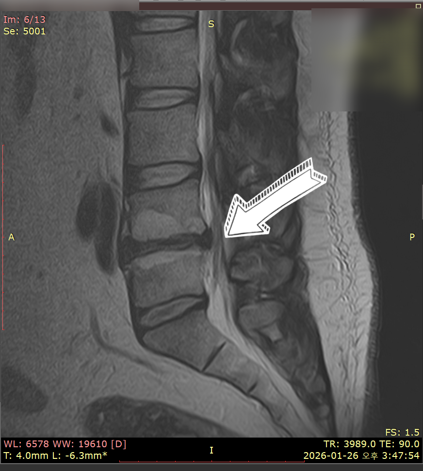 허리 MRI 사진에서 디스크 탈출증을 가리키는 화살표