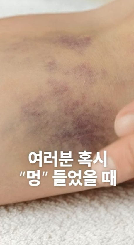 피부에 여러 개의 보라색 멍이 든 모습