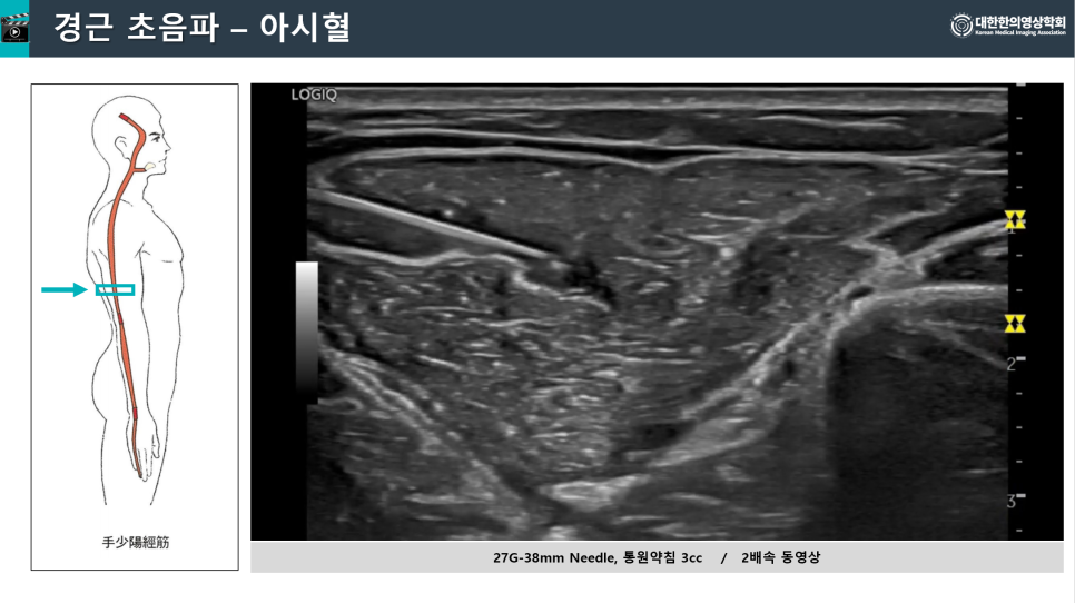 인체 측면도와 특정 부위를 가리키는 화살표, 그리고 근육에 침이 삽입된 초음파 영상.