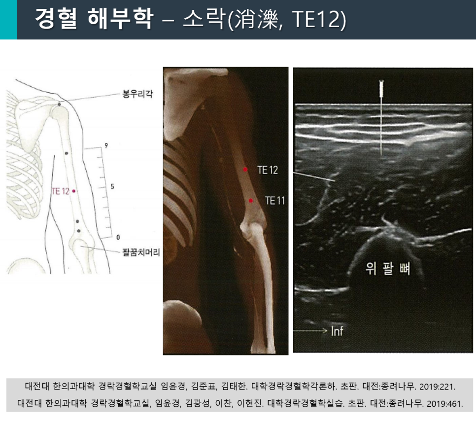 팔의 경혈점 TE12의 해부학적 위치를 보여주는 그림, 엑스레이 이미지, 그리고 침 시술이 보이는 초음파 사진.