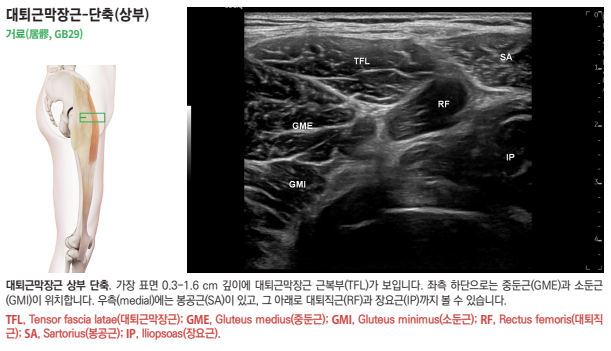 대퇴근막장근 상부의 해부학적 위치를 보여주는 인체 그림과 주변 근육이 표시된 초음파 영상.