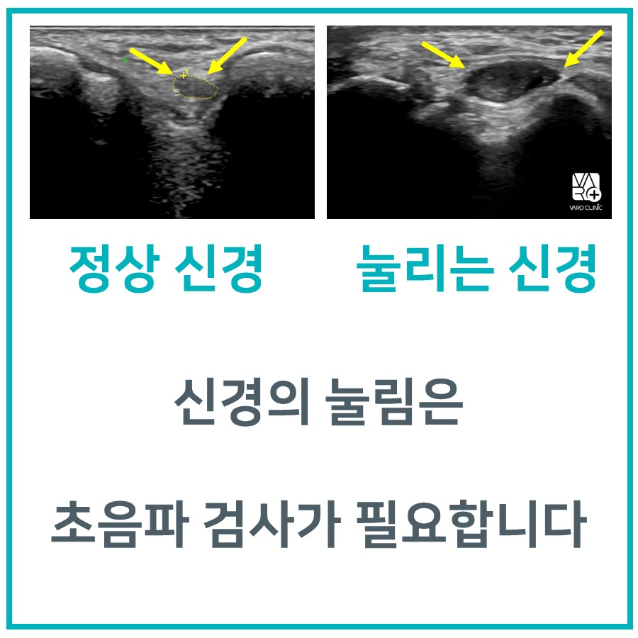 팔꿈치 저림, 통증, 팔꿈치터널증후군, 척골신경포착? 한의원에서 치료해야 하는 이유