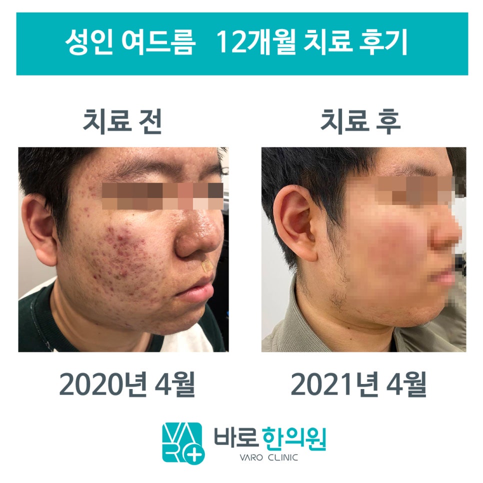 12개월 한약 치료 전 여드름이 많던 얼굴과 치료 후 개선된 얼굴을 비교한 사진