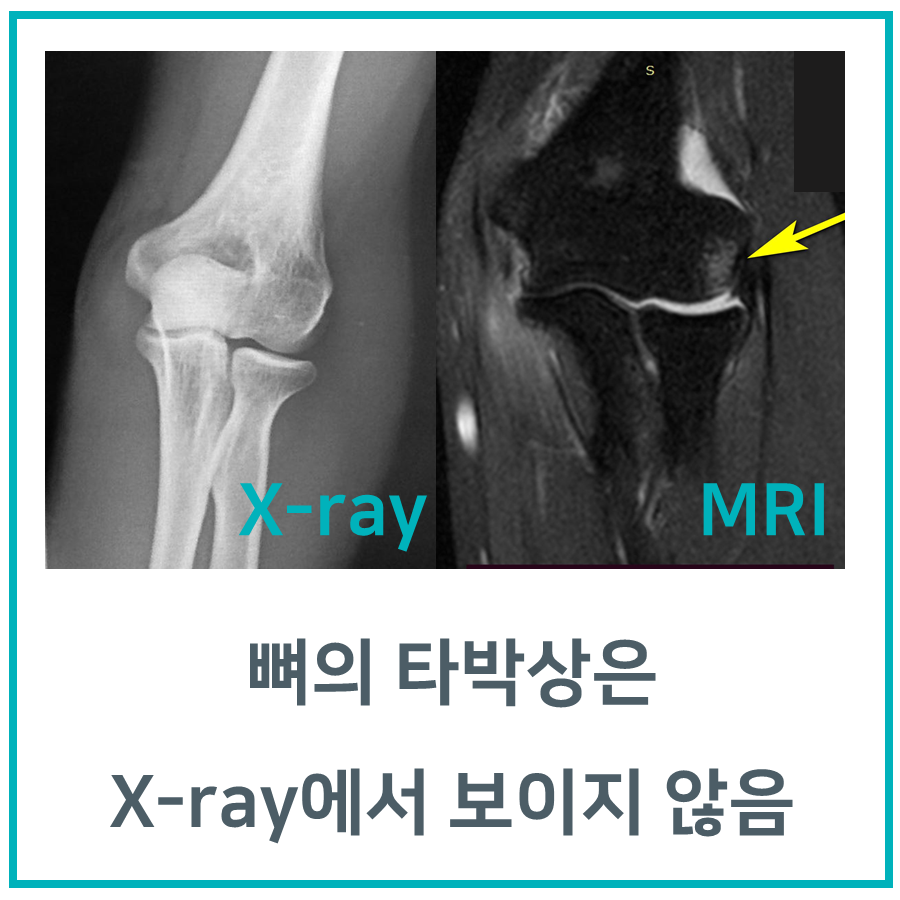 뼈 타박상, MRI 검사가 필요한 이유