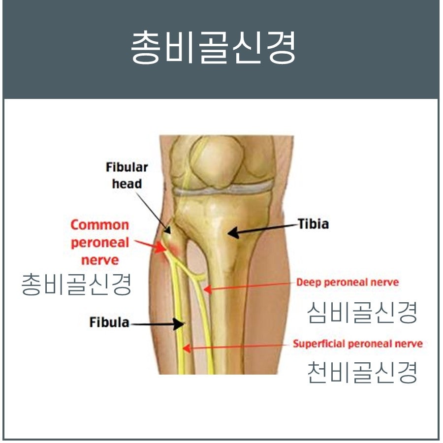 비골신경 마비, 초음파 한의원에서 치료하세요!