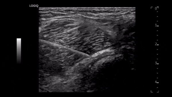 오십견 증상 진단 MRI 치료? <이것> 먼저 확인