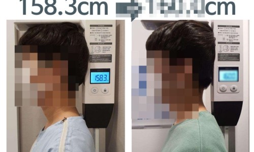 키 크는 [성장한약 + 척추교정 추나요법], 3개월 치료후기