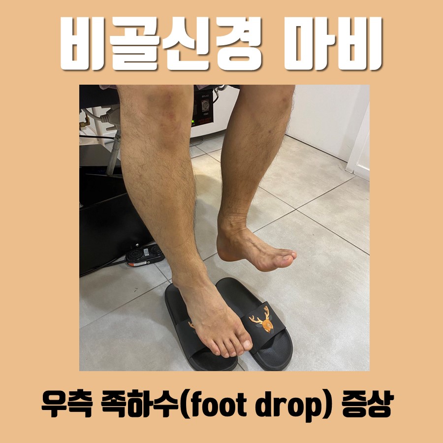 비골신경 마비, 족하수(foot drop)증상과 치료