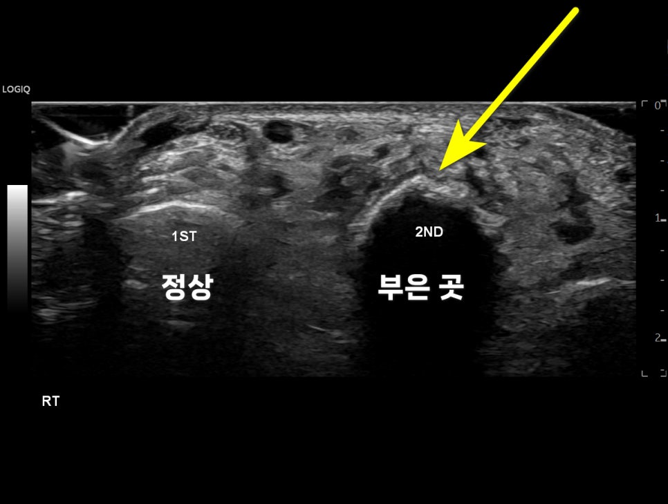 교통사고 발등 부음 혹 통증? 중족골 타박상에 <이 글>부터 읽어보세요