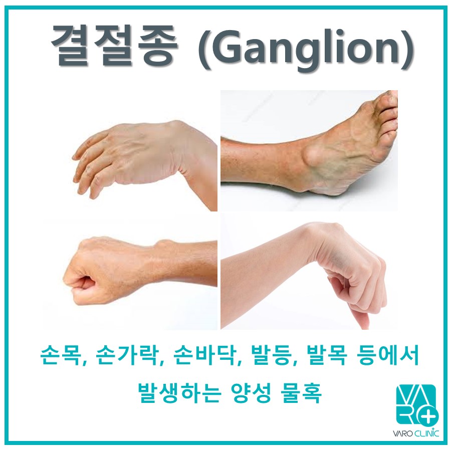 손목, 손가락에 물혹 수술 해야 하나요? [손목 결절종, 발등 결절종]