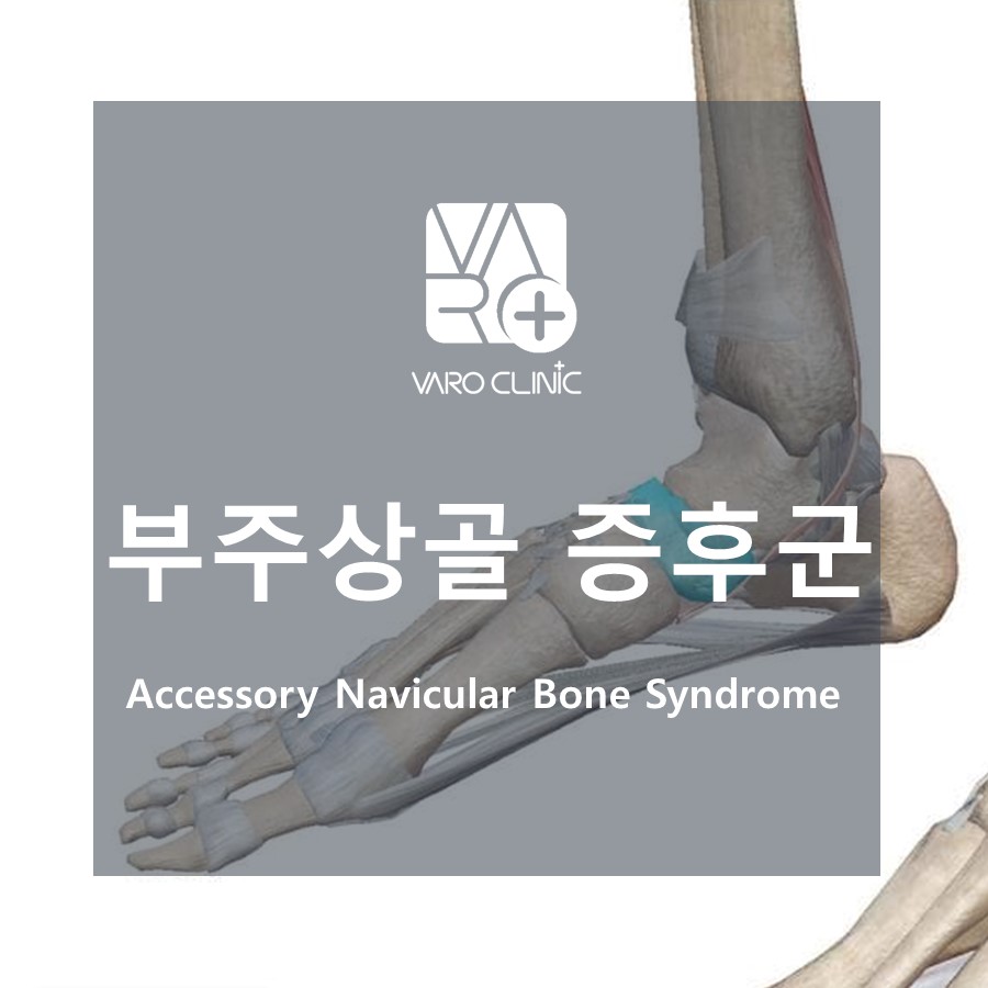 발바닥 부주상골 증후군? 방치하지 말고 치료하세요!