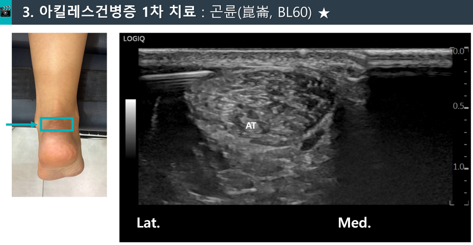 환자의 발목과 아킬레스건 초음파 사진