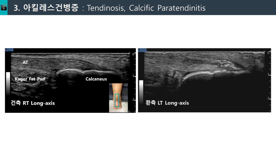 아킬레스건병증 초음파 사진으로, 건측과 환측의 종축 영상을 비교하여 보여준다.