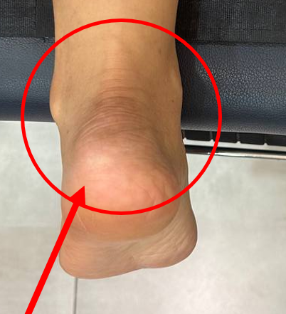 발목 뒤쪽과 발뒤꿈치 부위를 빨간 원과 화살표로 표시한 사진