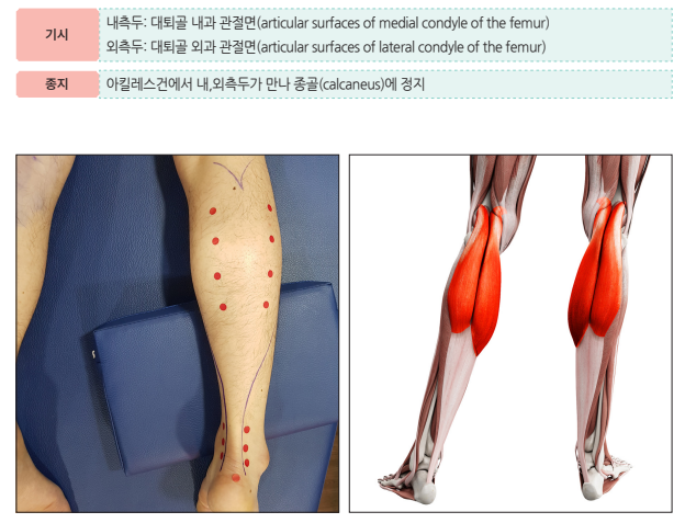 아킬레스건 관련 설명과 함께 다리에 표시된 붉은 점들, 그리고 종아리 근육 해부도