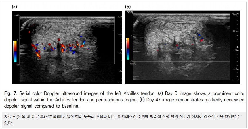 아킬레스건의 컬러 도플러 초음파 이미지로, 치료 전(왼쪽)과 치료 후(오른쪽)의 혈류 신호 변화를 보여준다.