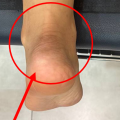 붉은 원으로 표시된 아킬레스건 부위가 보이는 발목 뒷면 사진.