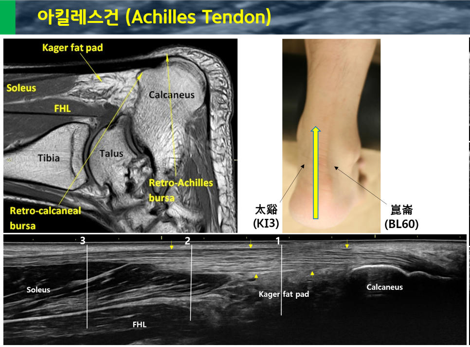 아킬레스건의 MRI, 초음파 영상과 발뒤꿈치 혈자리 사진을 함께 보여주는 이미지