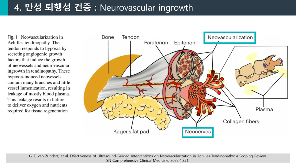 아킬레스건의 해부학적 구조와 신생혈관, 신생신경 증식을 보여주는 도해