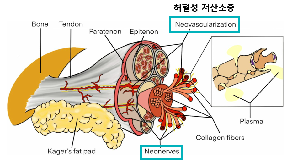 힘줄의 해부학적 구조와 허혈성 저산소증으로 인한 신생혈관, 신생신경을 보여주는 다이어그램입니다.