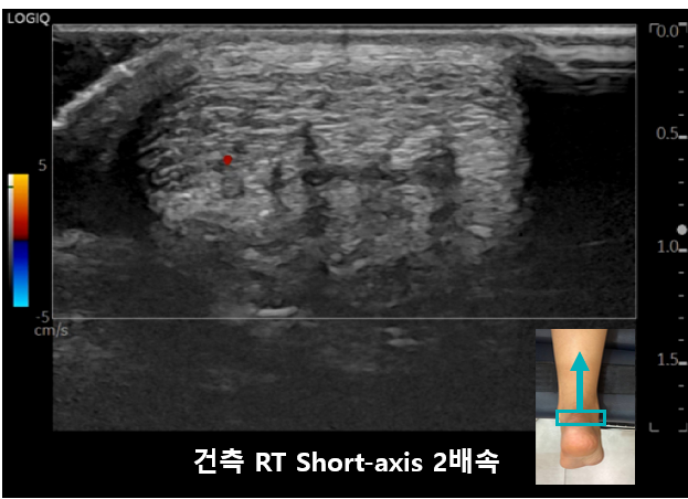아킬레스건의 초음파 사진으로, 붉은 점과 함께 발목 부위의 스캔 위치를 나타내는 작은 이미지가 보인다.