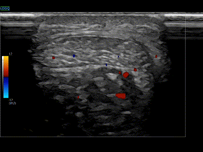 아킬레스건 부위의 초음파 영상으로, 혈류 신호가 나타나 있다.