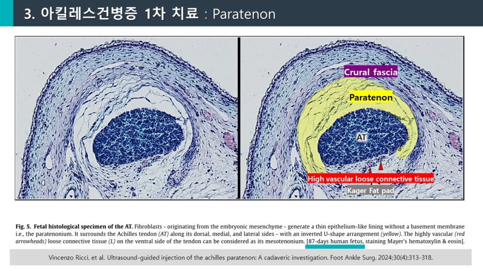 아킬레스건과 주변 조직의 태아 조직학적 표본 이미지. 오른쪽 이미지는 파라테논이 노란색으로 표시되어 있다.