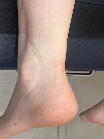 발목 뒤쪽 아킬레스건 부위에 부기가 있는 모습