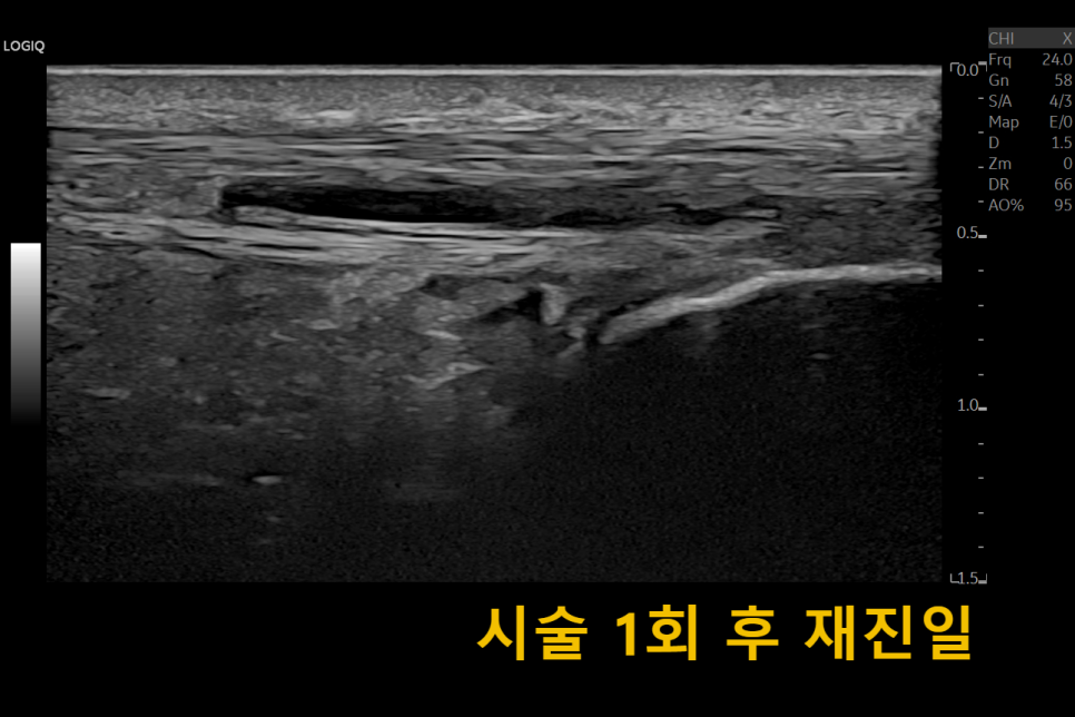 시술 1회 후 아킬레스건 부위의 물혹을 보여주는 초음파 사진