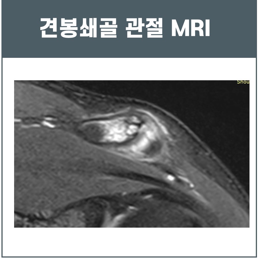 견봉쇄골 관절의 MRI 영상 — 서울 바로한의원 초음파 약침·도침