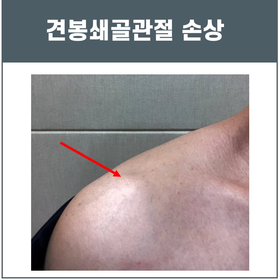 견봉쇄골관절염, 견쇄관절염 MRI 검사가 필요합니다