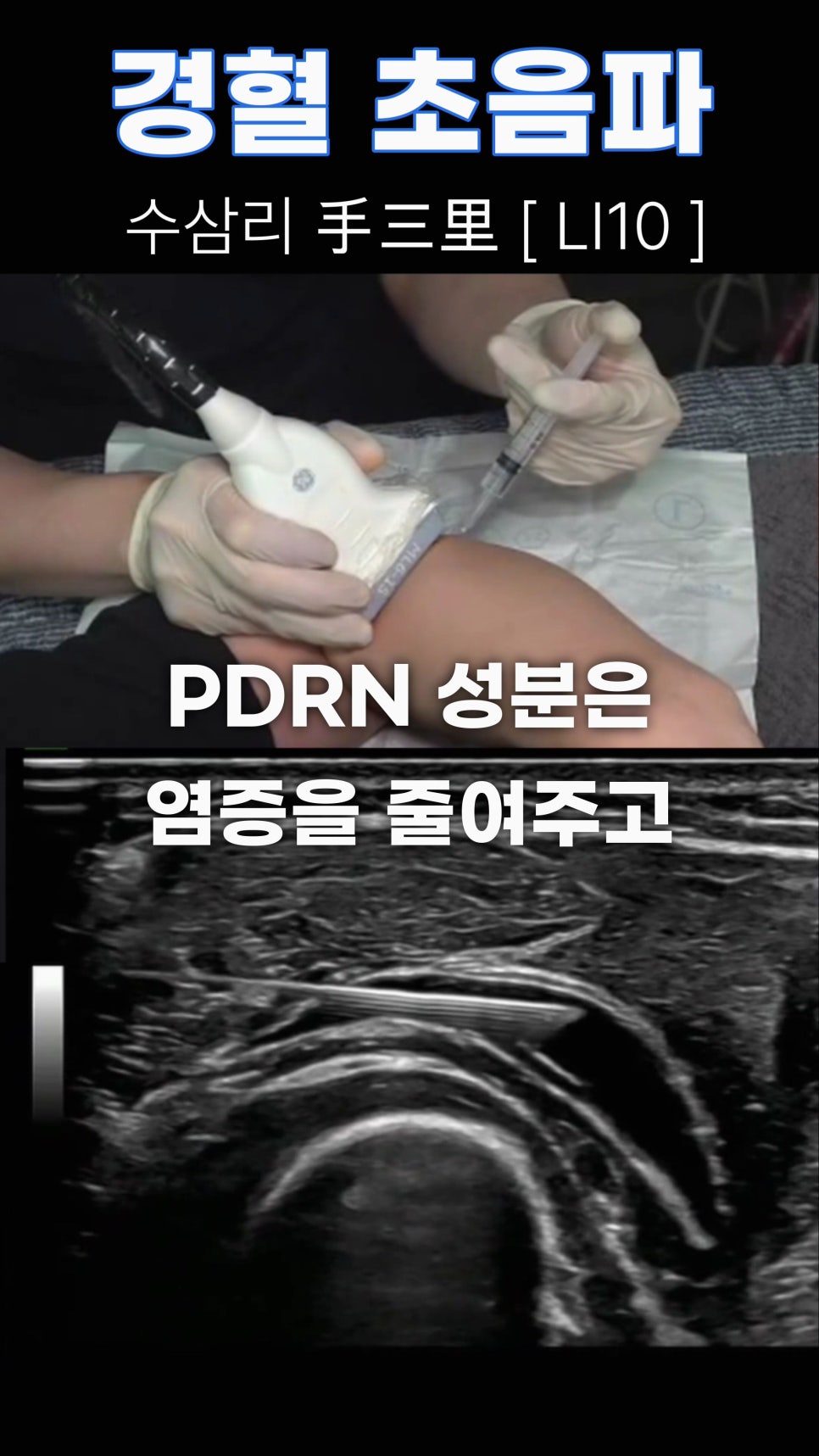 초음파 기기로 팔 부위의 수삼리(LI10) 경혈에 약물을 주입하는 모습과 주입 중인 바늘이 보이는 초음파 화면.