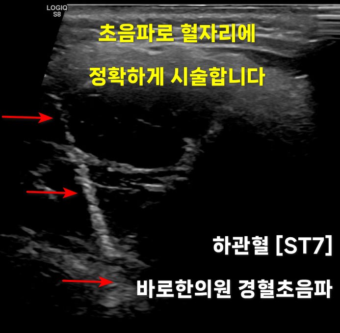 하관혈(ST7)을 초음파로 확인하며 시술하는 초음파 영상 — 초음파 유도하 약침 시술 | 서울 바로한의원