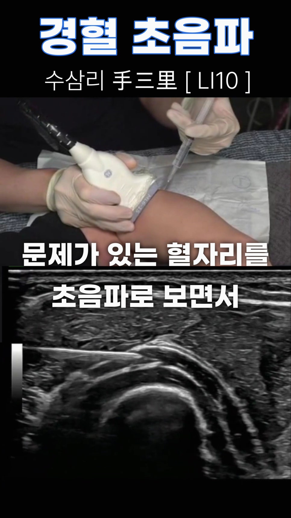 환자의 팔에 초음파 탐촉자를 대고 약물을 주입하는 모습과 주사 바늘이 보이는 초음파 영상.