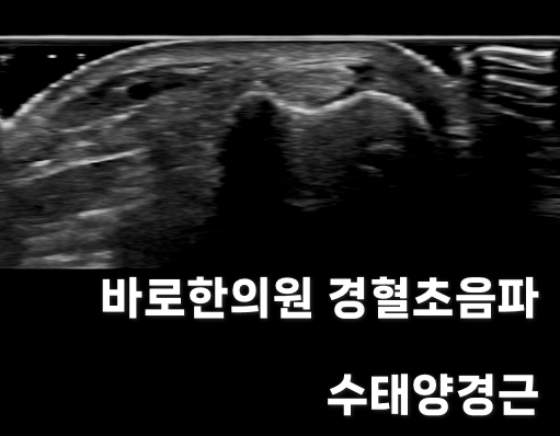 바로한의원에서 촬영한 손목 부위 수태양경근 경혈 초음파 사진
