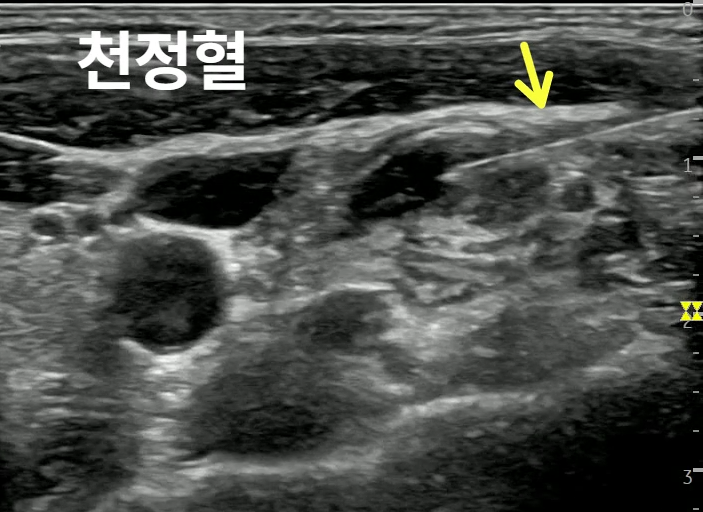 초음파 영상에서 천정혈 부위에 삽입된 침이 노란색 화살표로 표시되어 있습니다.