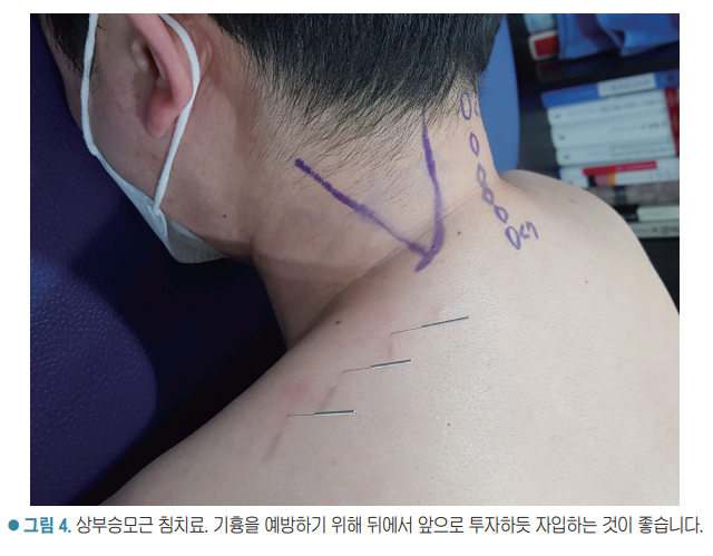 마스크를 착용한 사람이 엎드려 누워 목과 어깨 부위에 보라색 표시와 함께 침 치료를 받고 있는 모습 — 서울 바로한의원 초음파 약침·도침