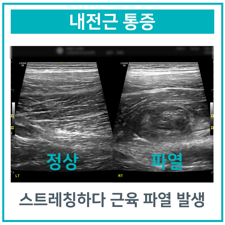 정상 내전근과 파열된 내전근을 비교하는 초음파 사진