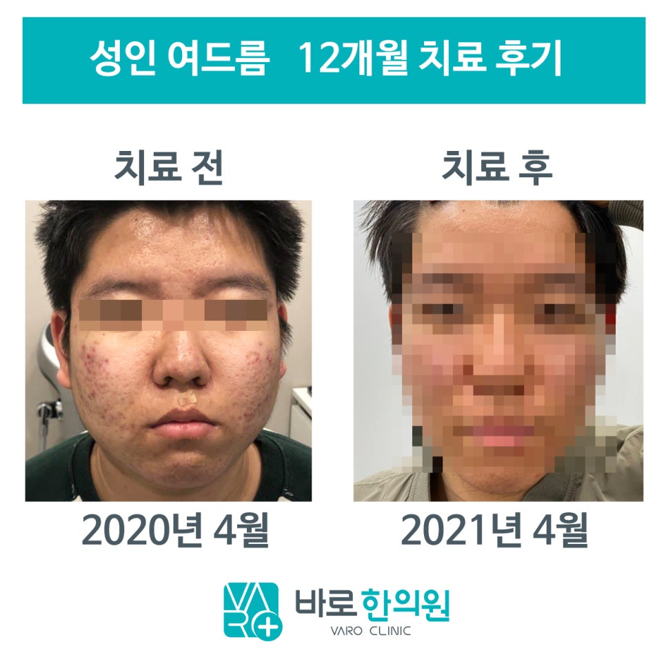 2020년 4월 여드름이 있는 얼굴과 2021년 4월 여드름이 개선된 얼굴을 나란히 보여주는 사진.