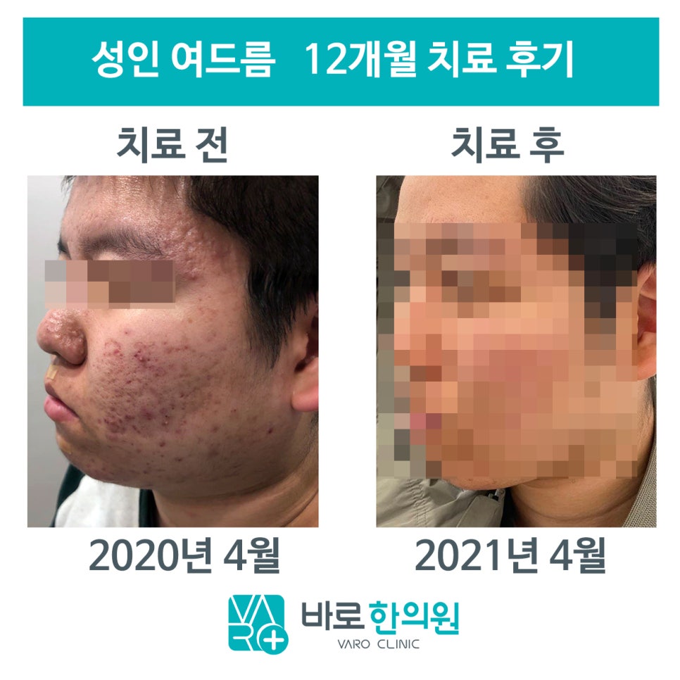 성인 여드름 12개월 치료 전후 사진. 치료 전 얼굴에는 여드름과 붉은 자국이 많고, 치료 후 얼굴은 여드름과 붉은 자국이 줄어든 모습이다.