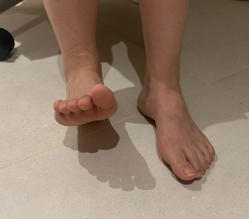Foot drop, 발목 처짐, 족하수? 비골신경 마비 골든타임을 놓치지 마세요 <초음파 약침>
